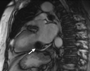 Steady-state free precession cine CMR image in modified two-chamber view, showing a hypointense mass (arrow) in the posterior region of the mitral annulus/basal segment of the inferior wall.