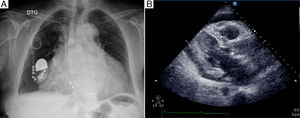 A) Radiografia de tórax a mostrar cardiomegalia, apagamento dos fundos de saco e um anel redundante do eletrocateter ventricular ao nível do aparelho valvular tricúspide. B) Ecocardiograma em modo B a evidenciar derrame pericárdico de médio volume ao nível da parede livre do ventrículo esquerdo (1,6cm) e de grande volume na parede do ventrículo direito (2,4-2,1cm).