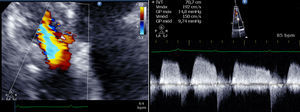 Ecocardiograma com Doppler a mostrar aliasing/turbulência do fluxo de entrada do ventrículo direito e Doppler contínuo a demonstrar um gradiente de ET com média de 10mmHg.