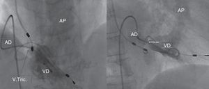 Cateterismo direito a revelar anormal posicionamento do eletrocateter de pacemaker no seu percurso e VT deformada, com amplitude de abertura reduzida.