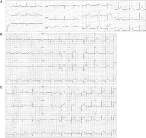 (A) Initial ECG showing ST-segment elevation in the anterior precordial leads. (B) Post-coronary angioplasty ECG showing normal sinus rhythm with resolution of ST-segment elevation and no anterior Q waves. (C) Acute stent thrombosis causing new ST-segment elevation in leads V1–V4 and slight ST-segment elevation in leads II, III, and aVF.