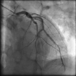 Left coronary angiogram showing no significant obstruction in the left anterior descending coronary artery (left anterior oblique view with cranial angulation).