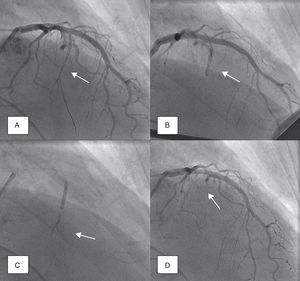 Angiographic demonstration of alcohol septal ablation technique. Left coronary angiography shows the target septal branch (arrow); an angioplasty guidewire is already inserted inside the septal branch (A). Optimal positioning of the balloon catheter (arrow) in the proximal part of the septal artery without compromise of the left anterior descending artery (B). Injection of angiographic contrast dye through the central lumen of the inflated balloon catheter (arrow) determines the supply area of the septal branch and excludes leakage into the left anterior descending artery or other coronary vessels (C). Final demonstration of the septal artery stump (arrow) after alcohol-induced occlusion (D).