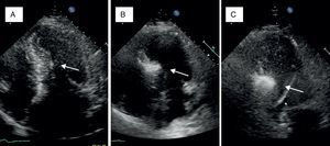 Myocardial contrast echocardiography during alcohol septal ablation. First, the anatomy of the heart is presented and the target septal area is identified (A). Injection of echocardiographic contrast into the target septal branch opacifies the basal part of the septum, verifying the optimal choice of septal branch (B). A more sustained opacification of the basal septum after alcohol injection signifies a good alcohol depot (C).