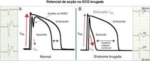 A Nos saudáveis, o potencial de ação dos miócitos ventriculares apresenta um pequeno entalhe na fase 1 mediado pela corrente ITO (mais evidente no epicárdio) sem tradução no ECG. B Na SB, o desequilíbrio iónico na fase 1 a favorecer a repolarização no epicárdio forma um gradiente de voltagem transmural que se traduz no ECG como o padrão de repolarização tipo 1.
