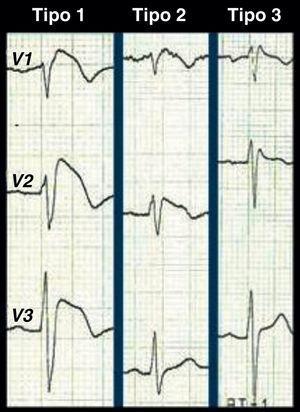 3 padrões de repolarização associados à SB.