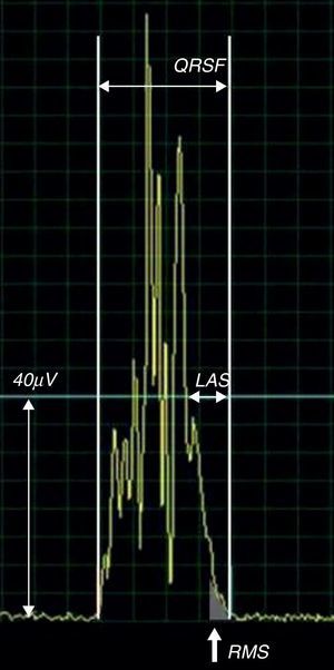 Os pós-potenciais ventriculares definem-se com pelo menos 2 de 3: duração total do QRS filtrado (QRSf) > 114ms, duração da parte final do QRS abaixo de 40μV (LAS) > 38ms e a voltagem nos últimos 40ms do QRS (RMS40)<20μV.