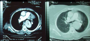 Computed tomography showing an aortic aneurysm (1).