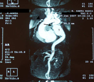 MRI angiography showing a thoracic aortic coarctation (arrow) with large poststenotic dilation (1), hypoplastic abdominal aorta (2) and enlarged internal mammary artery (arrowhead).