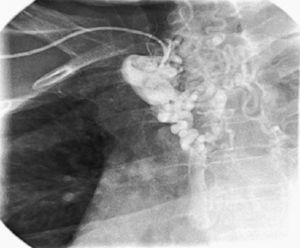Coronary angiography showing collateral circulation via the mammary artery.