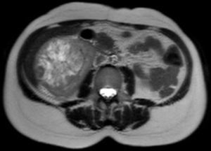 Aspecto do oncocitoma renal na ressonância magnética nuclear – corte transversal.