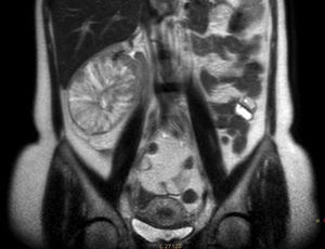 Aspecto do oncocitoma renal na ressonância magnética nuclear – corte coronal.