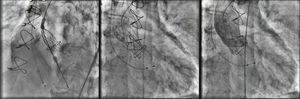 Posicionamento e libertação da prótese CoreValve.