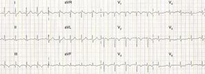 ECG com taquicardia sinusal, padrão de S1Q3T3 e inversão da onda T de V1 a V4 em relação com provável isquémia e/ou sobrecarga no ventrículo direito e região do septo intraventricular.