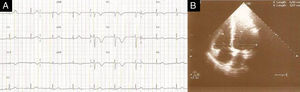 (A) ECG com bradicardia sinusal de 58 bpm, ausência de onda S em DI e inversão da onda T de V1 a V4. (B) ETT no plano apical de 4 câmaras no final da diástole com razão VD/VE <1 e PSAP=25mmHg.