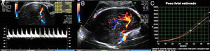 (A) Fluxometria doppler da artéria cerebral média direita. (B) Imagem parasagital craneana. (C) Peso fetal estimado.