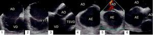 Incidências obtidas por ecocardiograma intracardíaco em doente com Foramen Ovale Patente. AD:aurícula direita; AE: aurícula esquerda; TSVD: trato de saída do ventrículo direito; VD: ventrículo direito; VT: válvula tricúspide; AO: aorta.