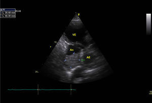 Imagem do trombo (seta) e aneurisma/pseudo-aneurisma póstero-basal do ventrículo esquerdo por ecocardiograma (Paraesternal Longitudinal).