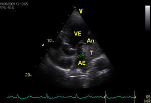 Imagem do trombo (seta) e aneurisma/pseudo-aneurisma póstero-basal do ventrículo esquerdo por ecocardiograma (5 câmaras).