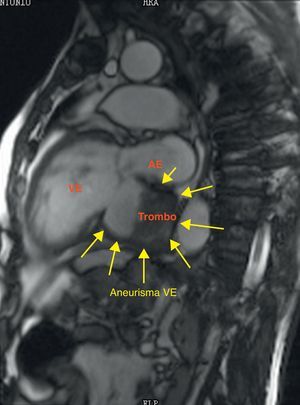 Imagem da ressonância magnética cardíaca (sequência de precessão livre em estado de equilíbrio estável em corte 2 cavidades) mostrando o volumoso aneurisma da parede inferior basal do ventrículo esquerdo com trombo intracavitário.
