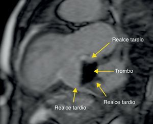 Imagem da ressonância magnética cardíaca (sequência de dupla inversão-recuperação 10min após a injeção de 0,2 mmol/kg de contraste paramagnético) mostrando a presença de realce tardio, aparentemente transmural, em toda a parede do aneurisma do ventrículo esquerdo.