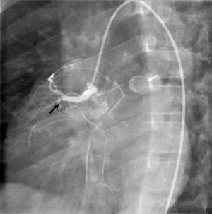 Coronariografia direita - coronária direita proximal ocluída (seta preta). A seta branca indica o aneurisma calcificado na origem da artéria descendente anterior esquerda.