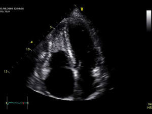 Ecocardiograma na incidência apical 4 câmaras: massa no apex do VD de ecogenicidade idêntica à do miocárdio.