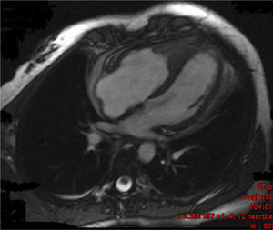 Imagem de RMC na incidência apical 4 câmaras: espessamento do miocárdio no apex do VD, com aspeto infiltrativo.
