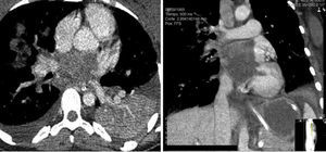 Cardiac computed tomography (CT): CT images showing the tumor occupying almost the entire left atrial chamber and infiltrating the pulmonary veins.