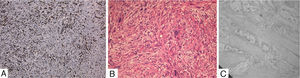 (A) Immunohistochemical stain. (B) Hematoxylin–eosin stain. (C) Electron microscopy.