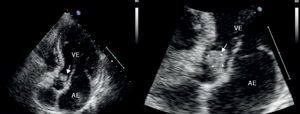 Ecocardiograma transtorácico, incidência apical de 5 câmaras, evidencia vegetação ao nível da válvula aórtica (seta). AE: aurícula esquerda; VE: ventrículo esquerdo.