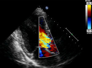 Ecocardiograma transtorácico modo Doppler, incidência paraesternal - longo eixo, demonstra insuficiência aórtica severa.