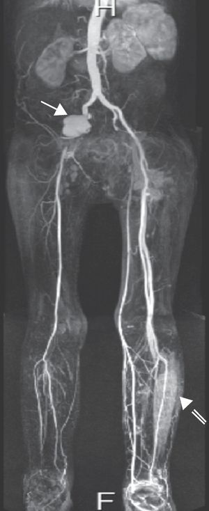 Angio-RM a demonstrar pseudoaneurisma do eixo arterial ilíaco direito (seta preenchida) e abcesso da perna esquerda (seta aberta).