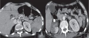 TC abdominal, a evidenciar êmbolo no tronco celíaco (seta fina), enfartes renais (seta larga) e esplénicos (asterisco).