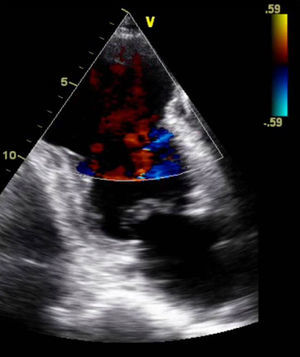 Ecocardiograma bidimensional em diástole, incidência apical 4 cavidades (esquerda) e Doppler de cor incidência apical 2 cavidades (direita), evidenciando aneurisma apical, de colo largo e com autocontraste no ventrículo esquerdo.