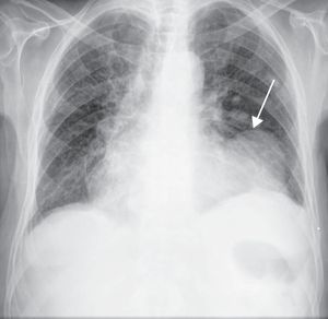 Rx torácico evidenciando a presença de cardiomegalia bem como de uma massa radio-opaca junto ao bordo esquerdo da silhueta cardíaca (seta).