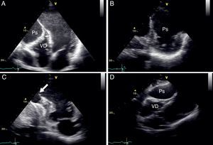 Ecocardiograma transtorácico bidimensional, incidência apical 4 cavidades (painel A), eixo curto (painel B), apical 2 cavidades (painel C) e subcostal (painel D), evidenciando a presença de pseudoaneurisma (Ps) ventricular esquerdo, de colo estreito (seta) e extensão ínfero-posterior, comprimindo o ventrículo direito (VD).