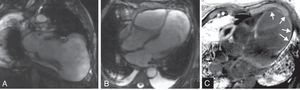 Ressonância magnética cardíaca, sequências cine (SSFP) nos planos eixo longo vertical (painel A) e 4 câmaras (painel B), confirmando a presença de volumoso pseudoaneurisma ventricular esquerdo. Imagens de realce tardio (PSIR) obtidas 10 minutos após a administração de gadolínio no plano 4 câmaras (painel C), observando-se área de retenção de produto de contraste transmural a envolver o aneurisma (seta).