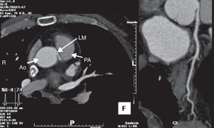 Reconstrução multiplanar (MPR); Ao-aorta; PA-artéria pulmonar; LM-tronco comum.