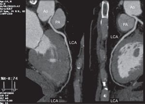 Reconstrução multiplar (MPR); Ao-aorta; PA-artéria pulmonar; LCA-artéria coronária esquerda.
