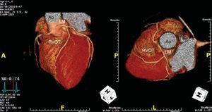 Reconstrução volumétrica (VRT); Ao-aorta; RVOT- tracto saída ventrículo direito; LM-tronco comum.