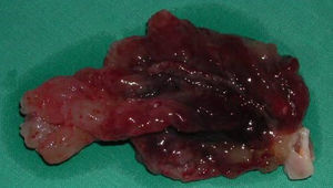Mixoma viloso, de consistência gelatinosa.