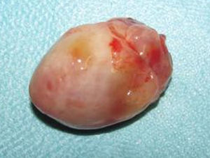 Mixoma sólido, de superfície lisa.