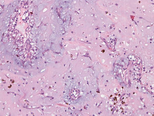Características histopatológicas habituais: células redondas, fusiformes e estreladas numa matriz laxa, edemaciada e mixoide. As células concentram-se à volta de alguns vasos. Há ligeiro infiltrado inflamatório (H&E).