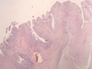 Mixoma com superfície papiliforme (H&E).