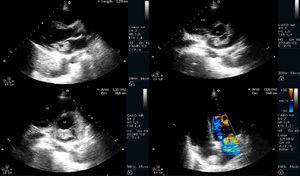 Ecocardiograma transtorácico: sequência de Imagens mostrando massa de 3,1cm aderente ao folheto anterior da válvula mitral, condicionando regurgitação mitral moderada a grave.