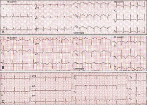Eletrocardiogramas seriados de uma doente com MT simulando um EAM anterior. A) Fase aguda: taquicardia sinusal e ↑ST V2-V6. B) Fase subaguda (2.° dia): ondas T invertidas em i, ii, iii, aVF, V3-V6. e C) Fase sub-aguda (5.° dia): tendência para a normalização, menor amplitude de inversão das ondas T.