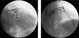 Angiograma coronário diagnóstico. Imagens obtidas em OAD 20° caudal 20° e OAD 10° craneal 40°. Observam-se lesões angiográficas correspondentes a estenose critica na descendente anterior proximal e muito grave na circunflexa média.