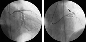 Angiograma coronário de controlo após implantação de stent a nível da descedente anterior proximal e circunflexa média. Bom resultado angiográfico a nível do local de intervenção. Observa-se «lesão de novo» na circunflexa proximal.