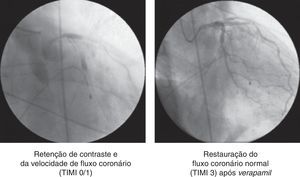 Na figura 4A observa-se retenção de contraste em vários pontos da árvore coronária e redução abrupta do fluxo coronário. A figura 4B é obtida após administração intracoronária de verapamil com restauração do fluxo coronário e resolução do intenso vasoespasmo difuso da árvore coronária esquerda.